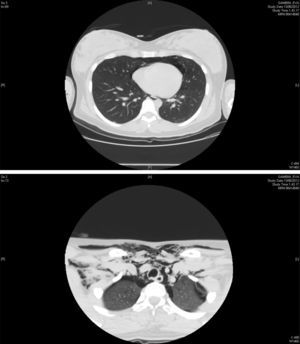 Chest CT showing a large pneumomediastinum associated with a minimum layer of bilateral pneumothorax, more visible on the left (maximum thickness 17mm) associated with huge subcutaneous emphysema in the sovraclavear region, in the neck and in the laterocervical bands bilaterally.