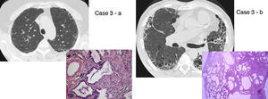 UIP/IPF identification in HRCT and histopathology. Case 1 – a: Common histopathological features of UIP/IPF consisting in honeycombing as a result of subpleural airway spaces confluence with bronchialization of epithelium where mucus cells may be predominant. HE 100×. Case 1 – b: The previous image aspects are revealed by higher production of mucus occupying the new formed subpleural smaller confluent airspaces. HE 100×. Case 1 – c: The interstitium intermingling honey-combing loses elastin fibres and is represented by fusiform cells, either fibroblasts or miofibroblasts, with collagen deposition. Elastin-van Gieson 100×. Case 2 – a: Irregular confluent air spaces with typical subpleural localization of UIP/IPF honeycombing with interstitium enlargement by fusiform cells. HE 100×. Case 2 – b: The adjacent lobular parenchyma accentuate histopathological heterogeneity, starting by overinflation and pseudo emphysema morphology. HE 100×. Case 2 – c: The lobular histopathological remodelling aspect of fibrosis enlarging alveoli septae till central bronchiolo-vascular axes and alveolar bronchialization. HE 100×. Case 3 – a: Small subpeural confluent air-spaces with bronchial-like epithelium and juvenile foci of fibroblasts in myxoid matrix; lymphocytes are seen. PAS 200×. Case 3 – b: UIP/IPF heterogeneous morphology in airspaces confluence with subpleural preponderance and committing the whole lobule. HE 100×.