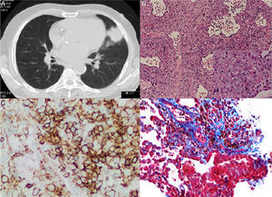(A) Chest CT scan showing a mass of 4.3cm×3.7cm in the lingular segment. (B) (HE 100×) – Polymorphic infiltrate in walls of blood vessels and alveoli, including large lymphocytes in aggregates (Inset: 400×). (C) Infiltrate with predominance of CD20+ B lymphocytes. (D) EBV-positive large atypical B cells.