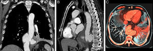Coronal (A), sagittal (B) and axial (C) reconstructions of computed tomography scan of the chest showing a large saccular aneurysm (72×52×54mm of diameter, T×AP×L) of the transition of the thoracoabdominal aorta with signs of contained rupture and alveolar consolidation in the left lower lobe.