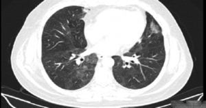 HRCT scan showing ground-glass pattern in the lower pulmonary lobes.
