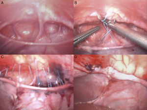 Operative view of the defect (A); stitches including plication of the sac (B) and diaphragmatic rim (C); final aspect after knots tying (D).