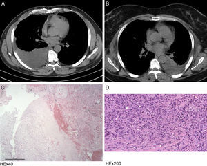 Radiological and histological features observed in the described clinical cases (Case 1: A and C, Case 2: B and D). (A) Chest CT image demonstrating a right pleural effusion with atelectasis of the adjacent lung parenchyma and areas with pleural thickening. (B) Chest CT image revealing a left pleural effusion with associated pulmonary atelectasis. (C) Photomicrograph illustrating the presence of lung parenchyma with mesenchymal neoplasm in continuity, with expansive margin and heterogeneously deposition of hyaline matrix with foci of hemorrhage. Stain: hematoxylin and eosin (HE); magnification: 40×. (D) Photomicrograph showing the presence of pleura involved by neoplasia, composed of epithelioid cells of irregular ovoid nuclei and eosinophilic cytoplasm, often with vacuoles and some erythrocytes inside. Stain: hematoxylin and eosin (HE); magnification: 200×.