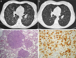 (A) Initial computed tomography (CT) scan of the thorax showed multiple diffuse bilateral small and well-defined noncalcified lung nodules. (B) CT scan of thorax one year after GnRH treatment documented shrinkage of lung nodules. (C) Low-power photomicrograph (hematoxylin-eosin stain) of a lung wedge resection by mini-thoracotomy; (D) immunohistochemistry of the lung nodule: diffusely positive for estrogen receptors, 200×.