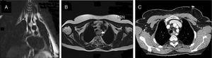 Magnetic resonance imaging showing the tracheal tumor (arrow) in sagittal (A) and coronal (B) planes compressing the esophagus but without invasion. (C) Follow-up chest CT 8 months after interventional endoscopy, demonstrating residual tumor (arrow).