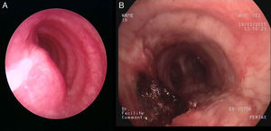 Endoscopic aspect before (A) and after (B) mechanical debulking and laser application.
