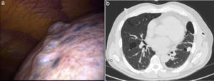 (a) Thoracoscopy shows cluster of cysts in the left superior lobe and (b) chest-CT shows multiple lung cysts with various size and irregular shape.