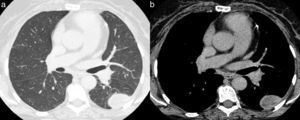 Axial chest computed tomography images obtained with the pulmonary (a) and mediastinal (b) window settings reveal a well-defined mass of probable extrapulmonary origin (the larger diameter is related to the pleural surface, and the mass, in its anterior portion, forms an obtuse angle with the chest wall), located posteriorly in the middle third of the left hemithorax, in close contact with the pleural surface.
