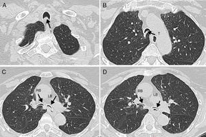 Chest CT scans of the studied patient show invagination of the posterior wall membrane of trachea (T) (Panels A, B) and of the main bronchi (Panels C, D) with narrowing of airways lumen. RB is for right main bronchus, LB for left main bronchus.
