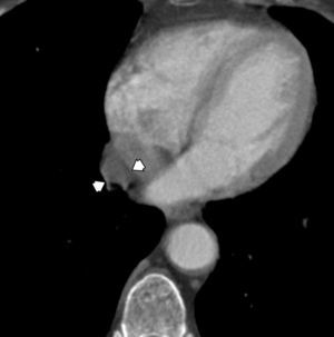 CT shows a cyst within the pulmonary ligament separated by fat plane from the pericardium.