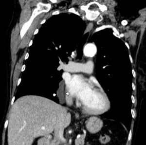 CT sagittal view shows the tubular cystic lesion laterally to the inferior vena cava, extending from the level of the right inferior pulmonary vein to the diaphragm.