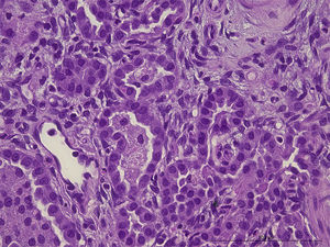 Histopathology – alveolar septa with mononuclear cell infiltrate, pneumocyte hyperplasia, increased intra-alveolar accumulation of macrophages and focally in the alveoli increased surfactant.
