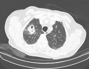 Computed tomography (CT) showing solitary pulmonary lesion in the upper right lobe. The lesion has irregular boundaries and a caveated component is exhibited.
