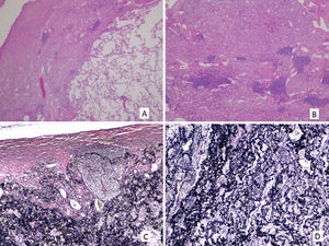Dense pleural and subpleural fibrosis with abrupt transition to non-affected pulmonary parenchyma (A, H&E 20×); subpleural elastosis and intra alveolar fibrosis with alveolar spaces and bronchioles imprisoned by the lesion, with bronchial associated lymphoid tissue hyperplasia (B, H&E 40×); diffuse and severe elastosis with curled, short and randomly oriented elastic fibres (C and D, EVG 100× and 200×).