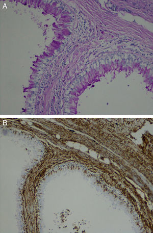 Type 0 CAM. (A) Irregular bronchial-like structures lined by pseudostratified ciliated columnar epithelium (PAS, ×400). (B) Columnar epithelium surrounded by prominent loose mesenchymal tissue (Vim, ×400).