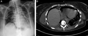 (A) Posterior–anterior view of chest radiograph with signs of pneumopericardium and left lower lobe opacification. (B) Chest CT showing pneumopericardium.