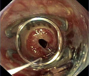 Esophagoscopy showing proximal end of the esophagopericardial fistula 30cm from teeth row in the postero-lateral region of the esophagus before placing an Over-The-Scope Clip.