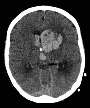 Axial view of brain CT showing contrast enhanced intracerebral hemorrhage.