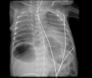 Anteroposterior chest X-ray. Two pneumatoceles in both lower inferior lobes.