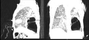 Chest CT scan. Pneumotoceles occupying the left lower lobe are seen (longitudinal length 34mm and 20×19mm of major axis). Pulmonary parenchyma shows areas of lower density of interstitial pulmonary emphysema.