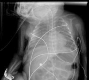Chest X-ray image after regression of the two pneumatoceles.