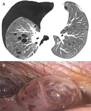 High resolution computed tomography of the thorax, axial scan at the level of the lower lobes (A) showing right pneumothorax, in addition to several cysts in the pulmonary parenchyma. Videothoracoscopy (B) evidenced the presence of subpleural cysts.