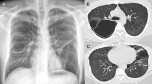 In A, chest X-ray in postero-anterior incidence shows a round hypertransparent area in the middle third of the right lung and left pneumothorax, besides parenchymal bands in the middle third of the left lung. In B and C, high resolution computed tomography of the thorax with axial sections at the level of the bronchial bifurcation (B) and the lower lobes of the lungs (C), performed days after the pneumothorax drainage, showing pulmonary cysts and small left residual pneumothorax (arrows).