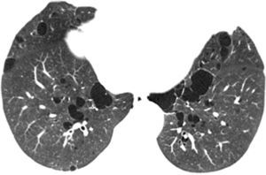 High resolution computed tomography of the thorax, axial scan at the level of the lower lobes showing multiple lung cysts of thin walls and varied sizes, presenting oval and irregular shapes.