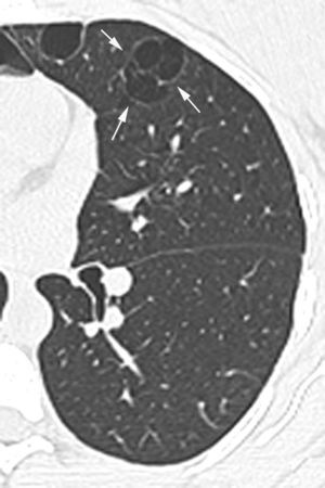 High resolution computed tomography of the thorax, axial scan at the level of the lower left lung, showing pulmonary cysts in the lingula, one of them with septations in the interior, assuming multiloculated appearance (arrows).