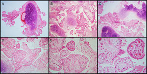 Histologic examination of PPT. On histologic examination, hamartoma is manifested by mature mesenchymal tissues but with abnormal configurations. These elements are represented by hyaline cartilage, fibrous tissue, adipocytic components and bone, with varying degrees of epithelial invagination. During the growth of hamartoma, prominent entrapped epithelial foldings showed peculiar papillary projections that resembles placental chorionic villi. The stroma of these placental villus-like structures contained fibroadipose tissue, blood vessels and variable number of inflammatory cells (i.e. plasma cells and lymphocytes) diffusely dispersed. The lining epithelium consisted of cuboidal and ciliated columnar cells (H&E – A, B and C – 40×, D – 100×, E – 200×, F – 400×).