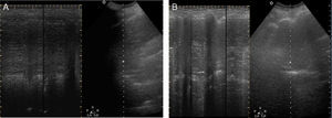 Thoracic ultrasound of patient with right diaphragmatic paralysis later confirmed as Pompe. There is decreased right diaphragm movement (A) and normal left diaphragmatic movement amplitude (B).