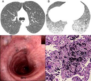 Inspiratory high resolution computed tomography axial scan (A) showing extensive centrilobular ground glass opacities and diffuse ground glass. Expiratory scan (B) showing ground-glass opacities and some lobular air trapping in the lower lobes. Bronchoscopy image showing small amount of secretion with anthracotic dots on trachea and main left bronchi (C). In (D) photomicrography showing interstitial anthracosis and multinucleated giant cell (hematoxylin–eosin, 200×).