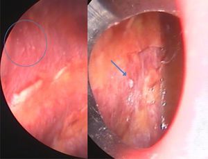 Thoracoscopy reveals small whitish nodular lesions at the costal pleura (circle, arrow).