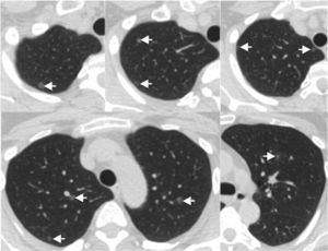 Chest CT demonstrating multiple ground-glass nodules randomly distributed on both lungs (arrows). There were no identifiable cysts.