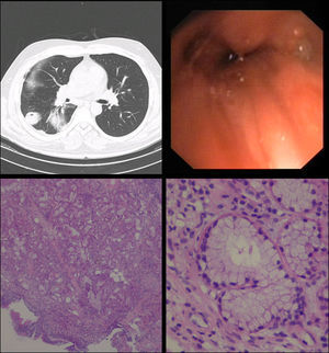 (A) Right lower lobe bronchiectasis and parenchymal densification. (B) Small protrusion in the right lower lobe bronchus. (C) Exophytic lesion composed by bronchial mucous glands, H&E 40×. (D) The glands had cell with monotonous basal nuclei and mucinous cytoplasm, H&E 200×.
