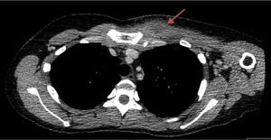 CT chest scan showing a 3cm diameter lump at the level of the left pectoral muscle (arrow).