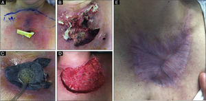 Different evolutionary stages of the disease. (A, B) Rapidly progressive ulcer with abundant purulent exudate. (C) Application of the system of negative aspiration (NPWT) on the ulcer bed. (D) Result after 7 days using the NPWT system and immunosuppression, where we can observe the disappearance of the exudate and the emergence of granulation tissue. (E) 6 months after onset we can observe that the lesion is fully healed.