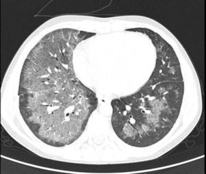 Thoracic computed tomography scan showing areas of ground-glass attenuation representing alveolar hemorrhage more pronounced in the right lower superior lobe.