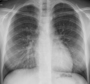 Chest radiograph illustrating reticular and fine micronodular opacities bilaterally.