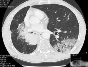 Chest-CT showing new ground-glass opacity in the posterior area of the left lower lobe after second administration of chemotherapy with pemetrexed and carboplatinum.