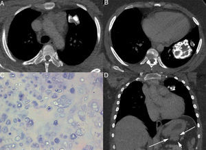 Chest computed tomography shows a nodule with a 3-cm diameter (A) and a well-circumscribed mass measuring 6×4cm (B), both with coarse calcifications. Microscopically, the tumors correspond to a benign cartilaginous neoplasm composed of well-differentiated chondrocytes, compatible with chondroma (C). Abdominal computed tomography (D) demonstrates an exophytic lobulated mass in the gastric wall (arrows).