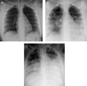 Radiological course of a reference patient with viral pneumonitis and acute respiratory distress syndrome secondary to influenza A/H1N1 infection. (A) Admission to emergency room. (B) Admission to Intensive Care Unit. (C) 6h after admission to Intensive Care Unit.
