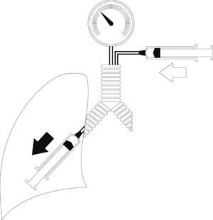 Determinants of Paw during inspiration. During inspiratory effort, two pumps in series (the ventilator and the respiratory muscles of the patient) determine the gas volume in the airway, and consequently also Paw. The ventilator contributes gases to the airway from the exterior (Qvent; hollow arrow), while the patient extracts gases toward the lung parenchyma (Qpac; solid arrow) (see text).