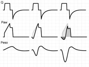 Flow dyssynchrony. The figure shows the tracings corresponding to Q, Paw and Peso of respiration under volume-controlled ventilation with no inspiratory muscle activity (left), with moderate effort (center), and with important effort (right). In the patient-triggered cycles, the passive Paw tracing has been left as reference to illustrate the impact of progressive inspiratory effort upon Paw. The medium gray-colored zone represents respiratory effort supported by the ventilator, the light gray zone shows the part of respiratory effort supported by the patient, and the dark gray zone shows the respiratory effort generated by the ventilator (and also supported by the patient).