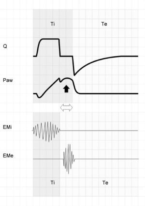 The upper zone shows tracings of Q and Paw corresponding to respiration under conventional mechanical ventilation with square flow wave and inspiratory pause. The lower zone offers a schematic representation of the electromyographic recordings of the inspiratory (EMi) and expiratory muscles (EMe). Note that Tipac is smaller than Tivent (double hollow arrow). After relaxation of the inspiratory muscles, exhalation does not take place because the airway is still pressurized. A few instants later, the patient activates the expiratory muscles, producing an end-inspiratory increase in Paw (solid arrow).