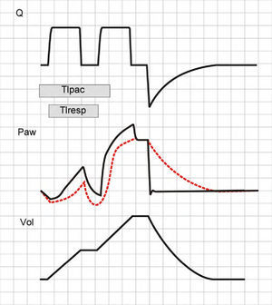Double cycling in volume-controlled ventilation. When the Ti of the patient (Tipac) is greater than the Ti of the ventilator or respirator (Tiresp), the patient continues inspiration against the already closed inspiratory valve, causing the drop of Paw and, if the triggering threshold is exceeded, a new inspiratory cycle is started in which the second tidal ventilation (TV) adds to the first.