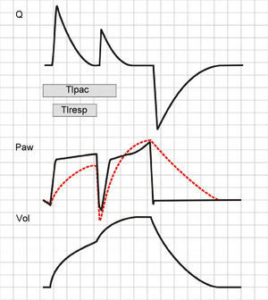 Double cycling in pressure-controlled ventilation. In the same way as in volume-controlled ventilation, the prolongation of Tipac beyond the limits of Tiresp can cause a drop in Paw, starting a new inspiratory cycle. However, in contrast to the situation in volume-controlled ventilation, tidal ventilation is not doubled (see text).
