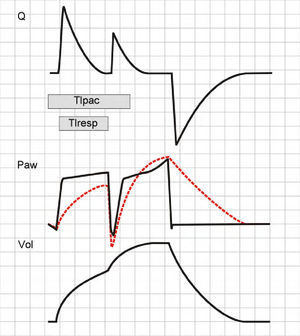 Double cycling in pressure-controlled ventilation. In the same way as in volume-controlled ventilation, the prolongation of Tipac beyond the limits of Tiresp can cause a drop in Paw, starting a new inspiratory cycle. However, in contrast to the situation in volume-controlled ventilation, tidal ventilation is not doubled (see text).