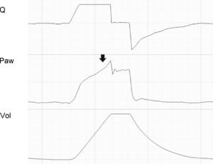 Tracing corresponding to a patient with conventional mechanical ventilation. Excessive tidal ventilation causes overdistension at the end of inspiration, reflected as a change in the gradient of Paw (arrow).