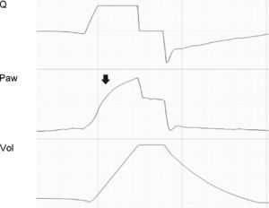 Tracing corresponding to a patient with conventional mechanical ventilation. The upper convexity at the start of inspiration (arrow) evidences a PEEP level insufficient to avoid the collapse at the end of expiration and the consequent inspiratory recruitment in the next cycle.